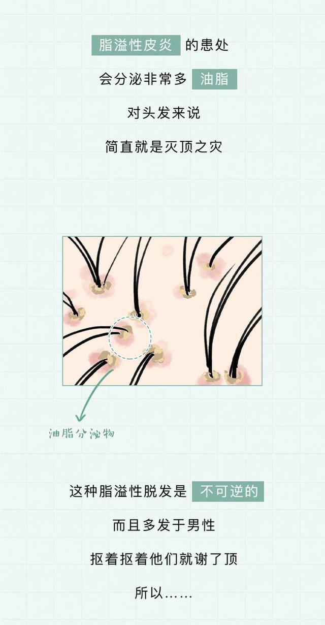 头皮上的白色颗粒,头皮上的白色颗粒是虱子吗