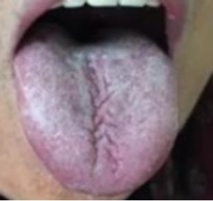 舌根部有裂纹是什么舌象,舌有裂纹7种原因通过舌象来调理