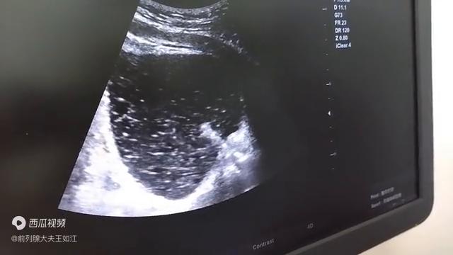 孔医生治疗前列腺炎,经尿道前列腺消融治疗步骤