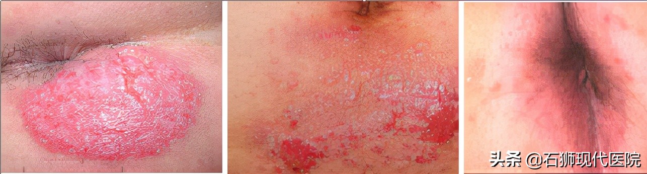 肛周湿疹瘙痒怎么治彻底,肛周湿疹痒得特别厉害怎么办