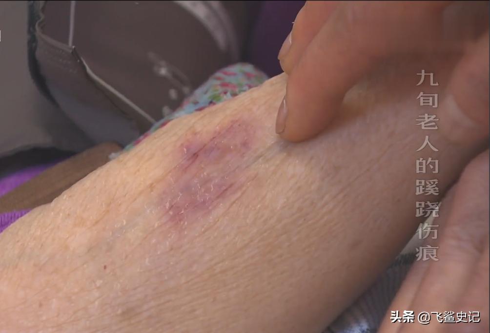 母亲被火灾烧伤,母亲被火烧死后续