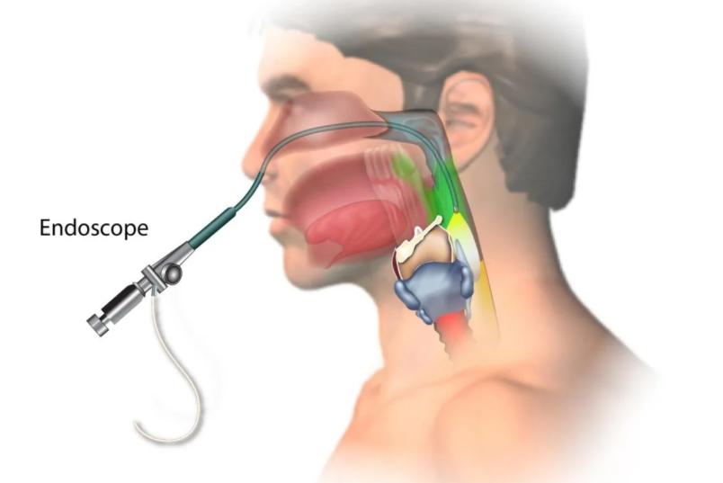 什么叫做做喉镜,做喉镜一般是什么病