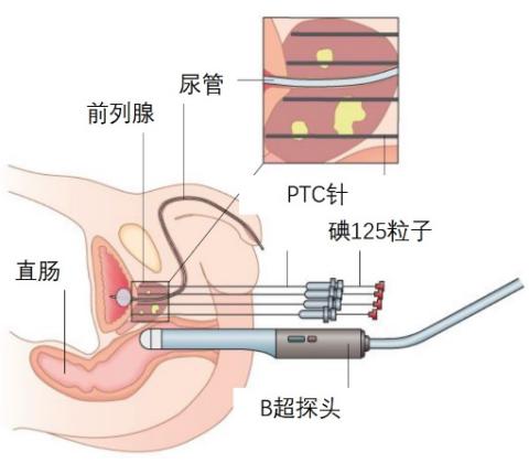 神奇的粒子—前列腺癌患者纷纷点赞的125I粒，术后三天即可出院。
