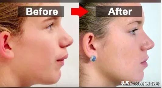 嘴凸怎么改善最有效果,23岁改变口呼吸可以改善嘴凸吗