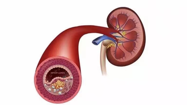 清理血管垃圾打吊瓶,年纪大了打扩血管针好吗