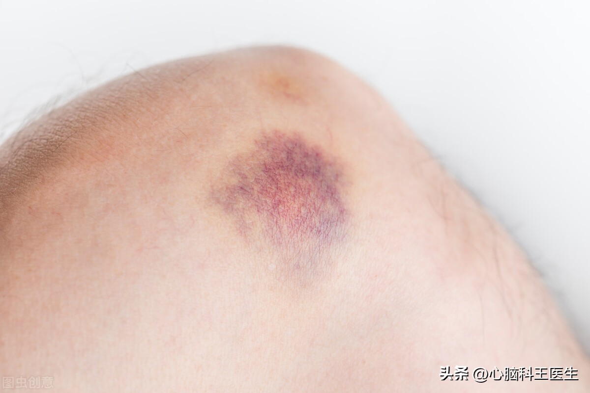 吃阿司匹林引起牙出血要停服吗,吃阿司匹林引起肠道出血吗