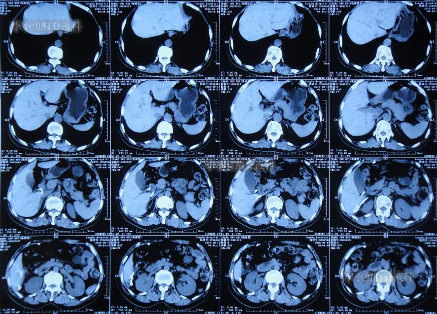 脑积水手术后4天还呕吐怎么回事,脑积水分流术后一直腹部疼痛