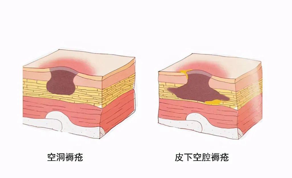 黑痂型褥疮最佳治疗方法,褥疮起黑痂很硬一直不好怎么办