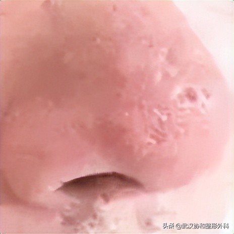酒糟鼻导致鼻子肥大怎么办,酒糟鼻鼻子变大变厚怎么治疗