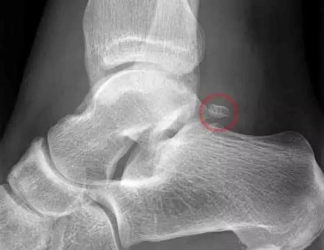 脚踝疼痛别大意，警惕这个疾病找上门！