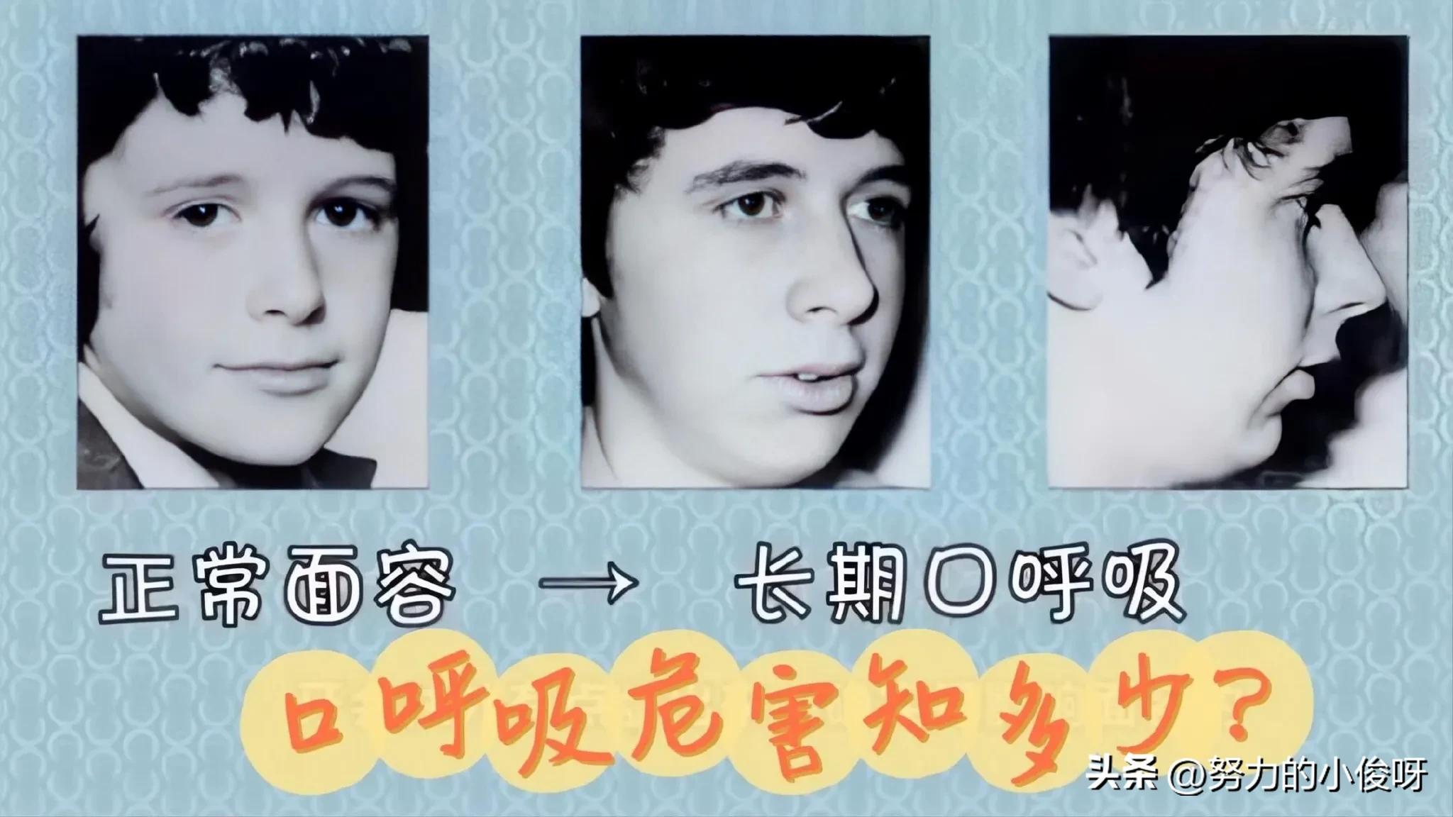嘴凸怎么改善最有效果,23岁改变口呼吸可以改善嘴凸吗