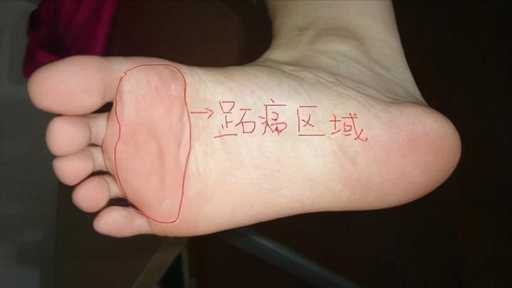 脚底板爱进风什么原因,脚底板走路磨起茧子怎么去