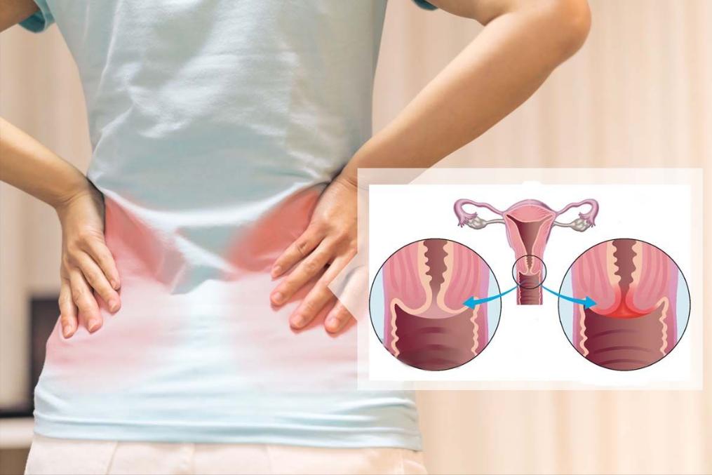 妇科引起的腰骶痛是怎么回事,由妇科炎症引起的腰酸痛怎么办