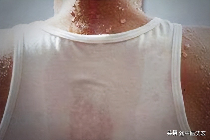 胃有火舌体胖大,胃有火舌头发黑