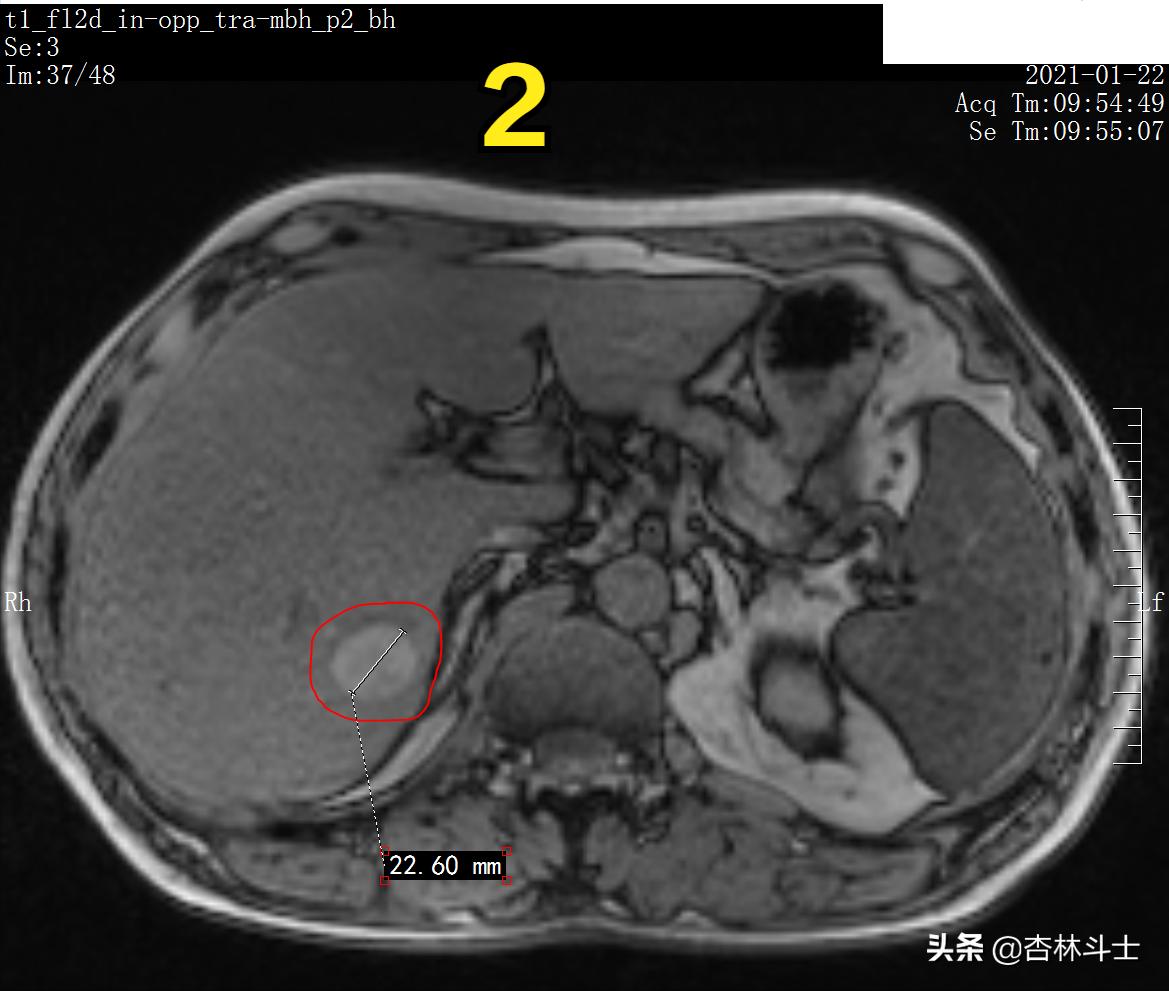 肝癌8公分肿瘤能活多久,肝癌细胞最大长多大