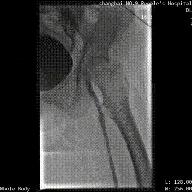 中国医院血栓清除技术,血栓消除的高端技术