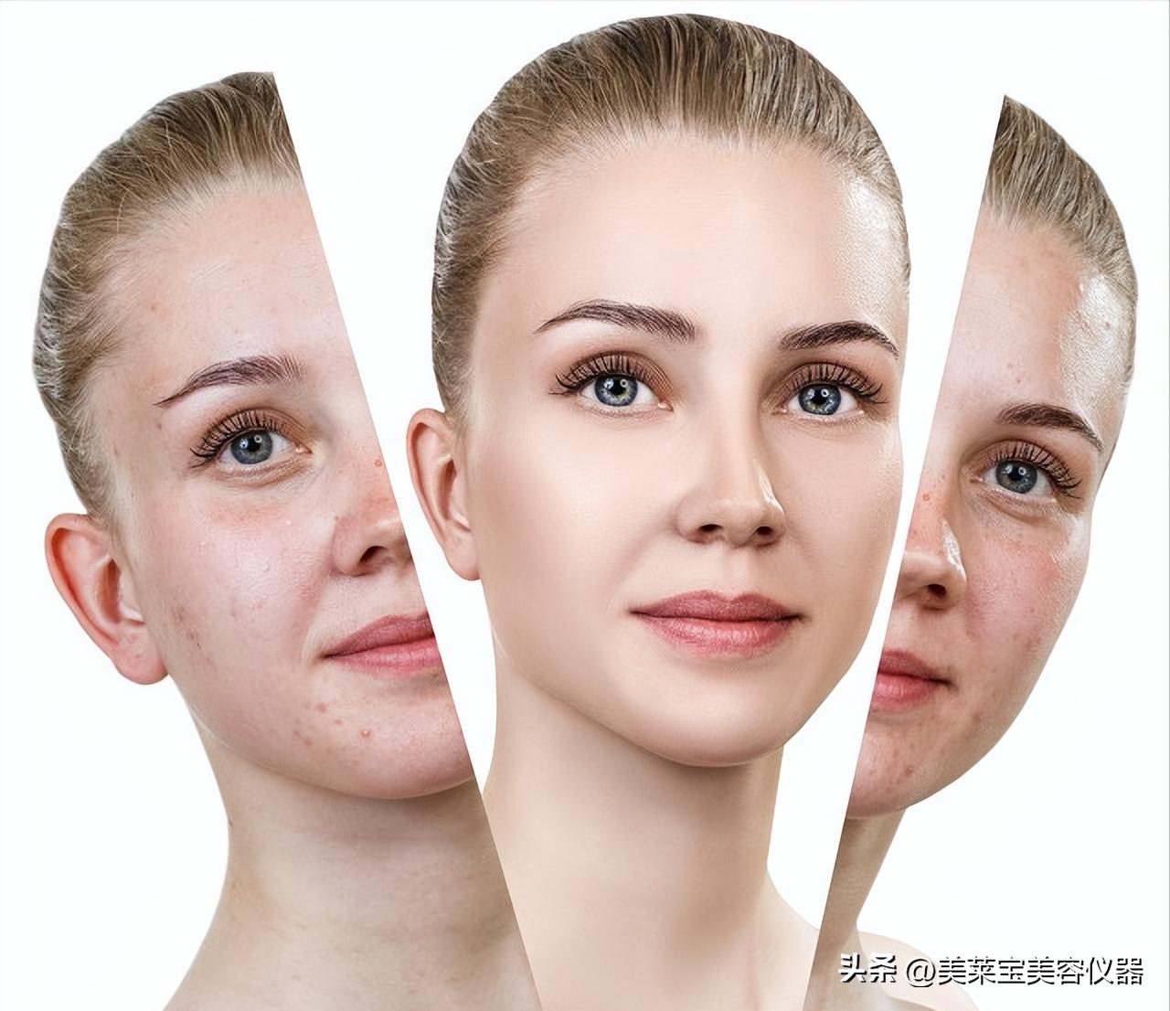 皮肤总是出油毛孔堵塞长粉刺,脸上皮肤毛孔堵塞卡粉怎么办