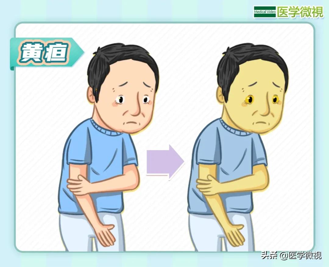 肝病的五大表现你中了几个,肝病早期九大征兆