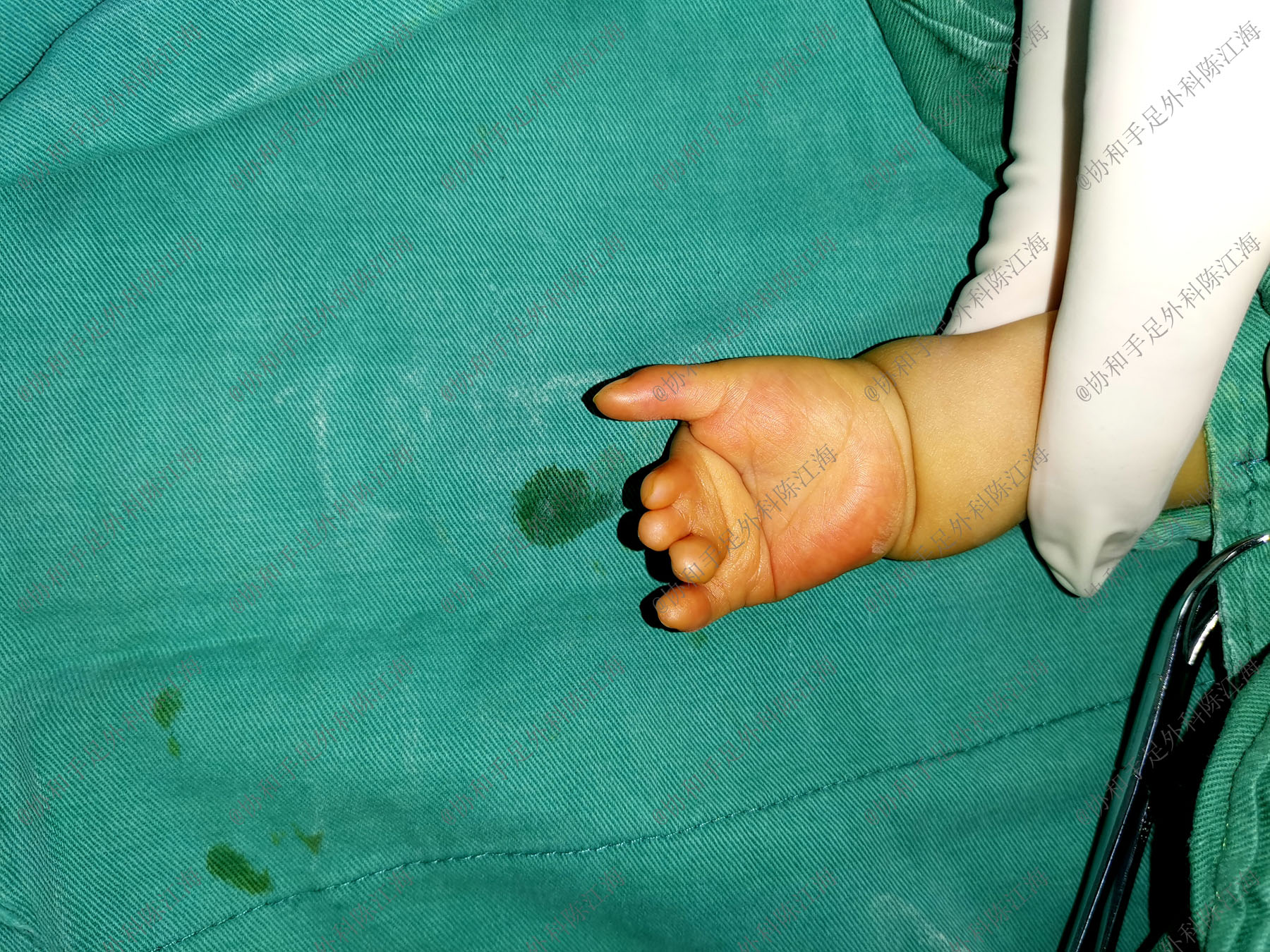 儿童做了植皮长大还需要植皮吗,小孩植皮后长大后还需要植皮吗