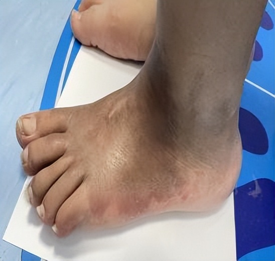 脚底板血管瘤介入治疗,脚底弥漫海绵状血管瘤