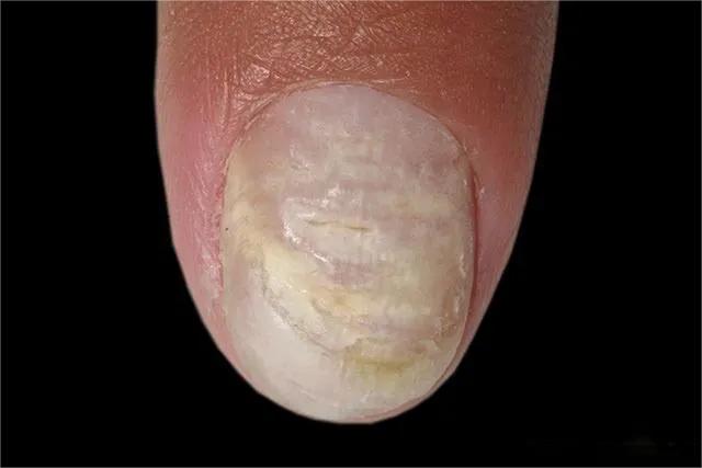 甲癣不严重怎么治疗,甲易生治疗灰指甲吗