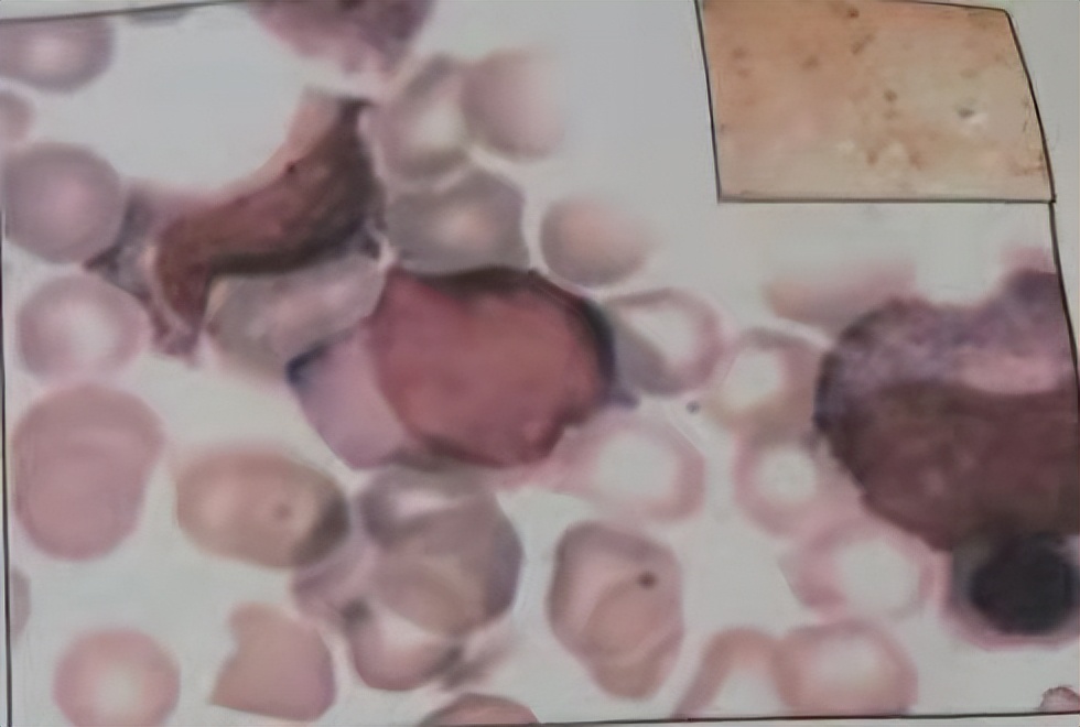 脂肪肝血液异常,脂肪肝的血常规表现