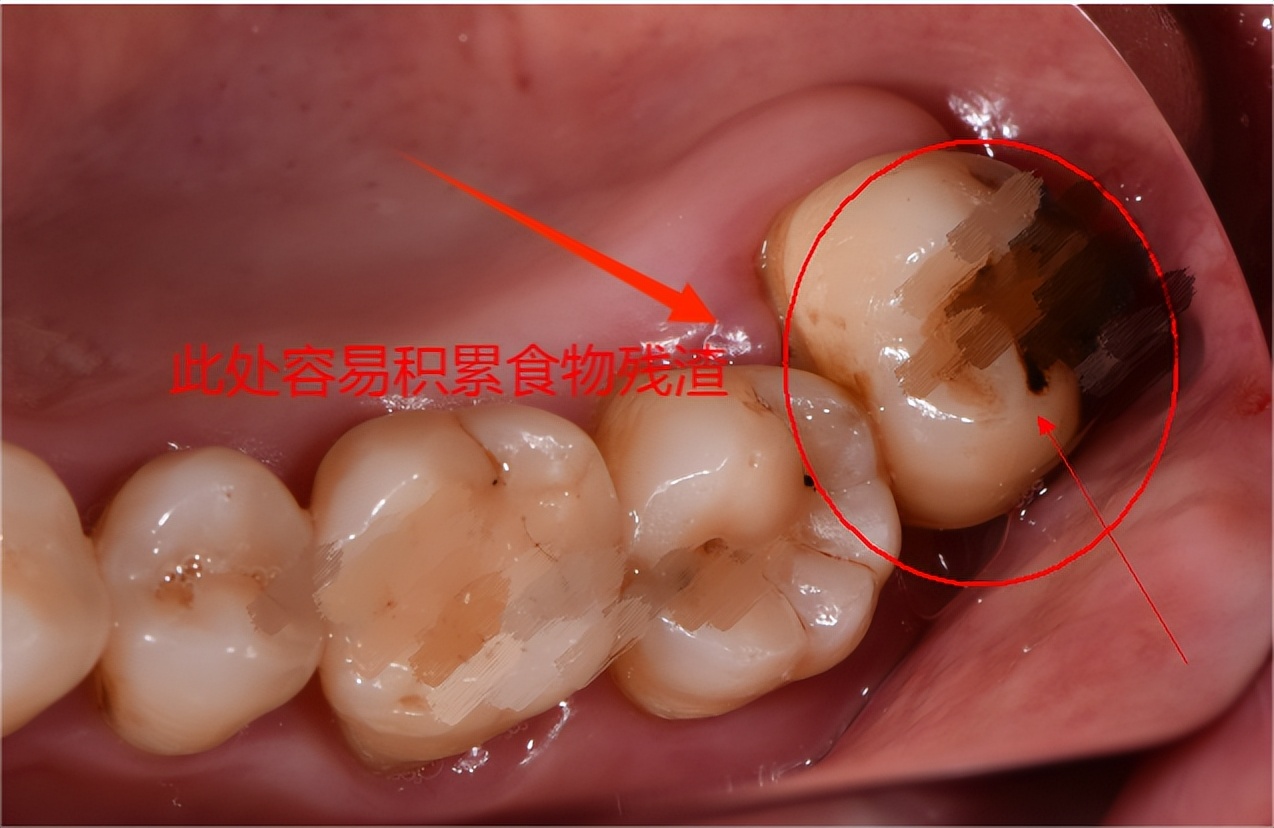 左下智齿拔除视频怎么正确拔除,复杂智齿拔除操作详细流程