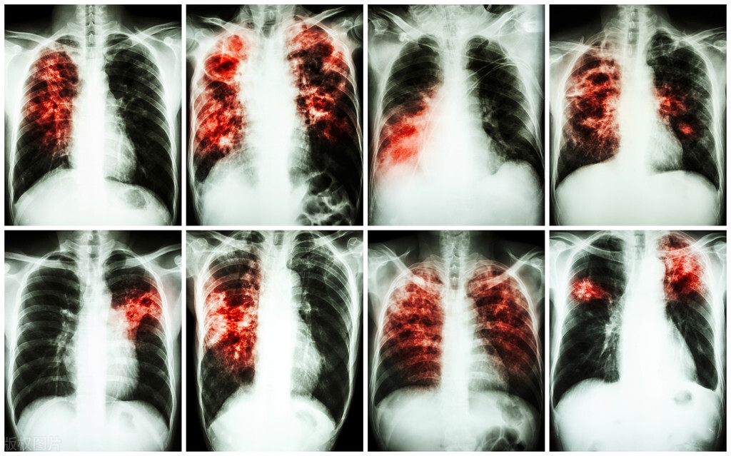 肺纤维化中医治疗方法研究,肺纤维化中医治疗医院排名