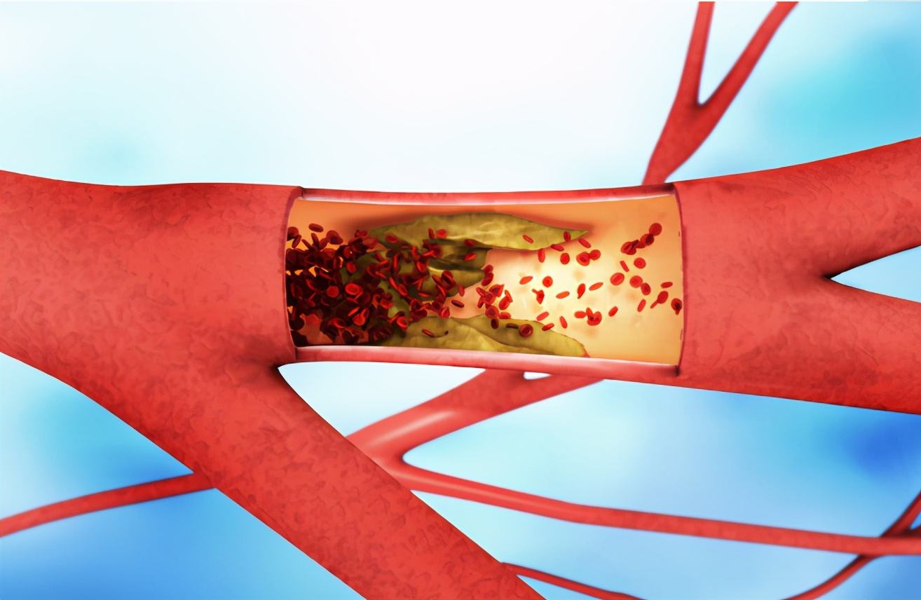 心梗用活血化瘀有效吗,预防心梗吃丹参滴丸行吗