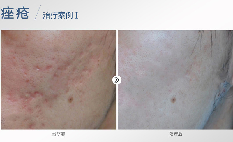 孩子起痘自卑不自信该怎么引导,孩子长青春痘不自信怎么引导