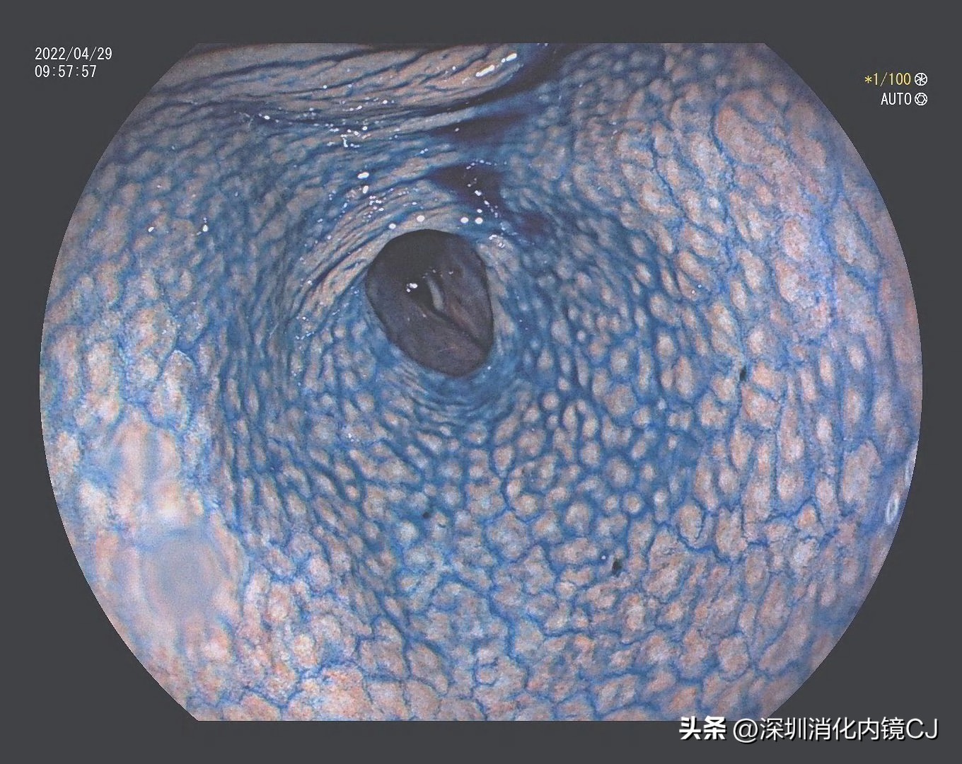 幽门螺旋杆菌感染胃粘膜表现,没有幽门杆菌但是胃窦鸡皮样改变