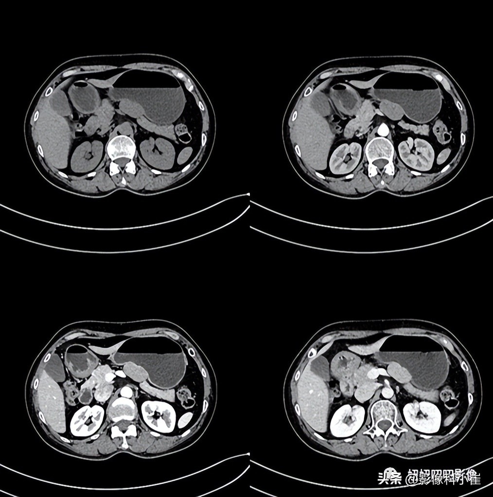 胃部肿瘤如果是恶性该怎么治疗,胃部肿瘤做什么能查出来