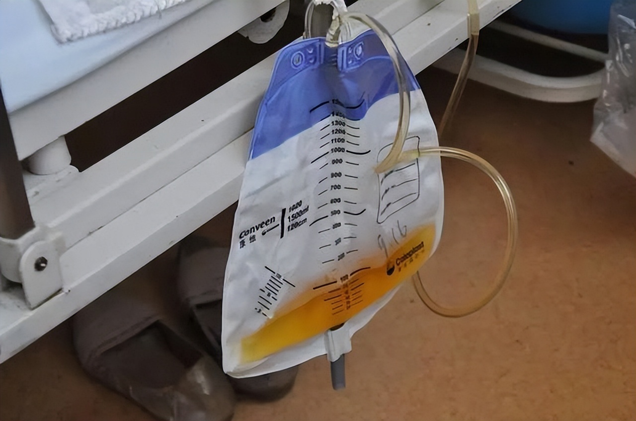 手术插尿管导致后遗症,做完手术插尿管有什么坏处吗