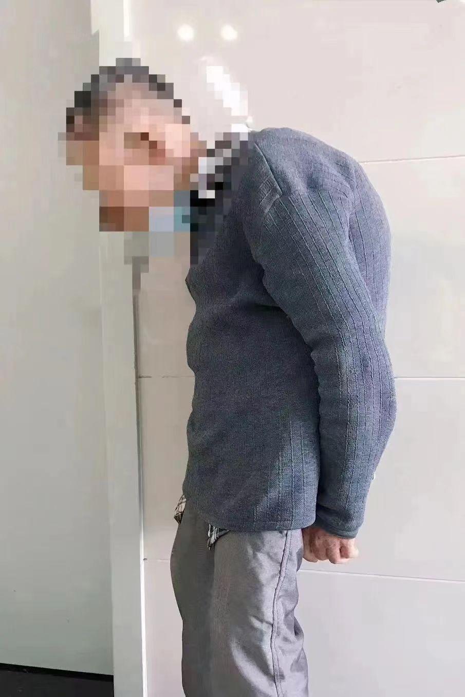 啃下“硬骨头”!苏高医成功为重度强直性脊柱炎患者实施麻醉