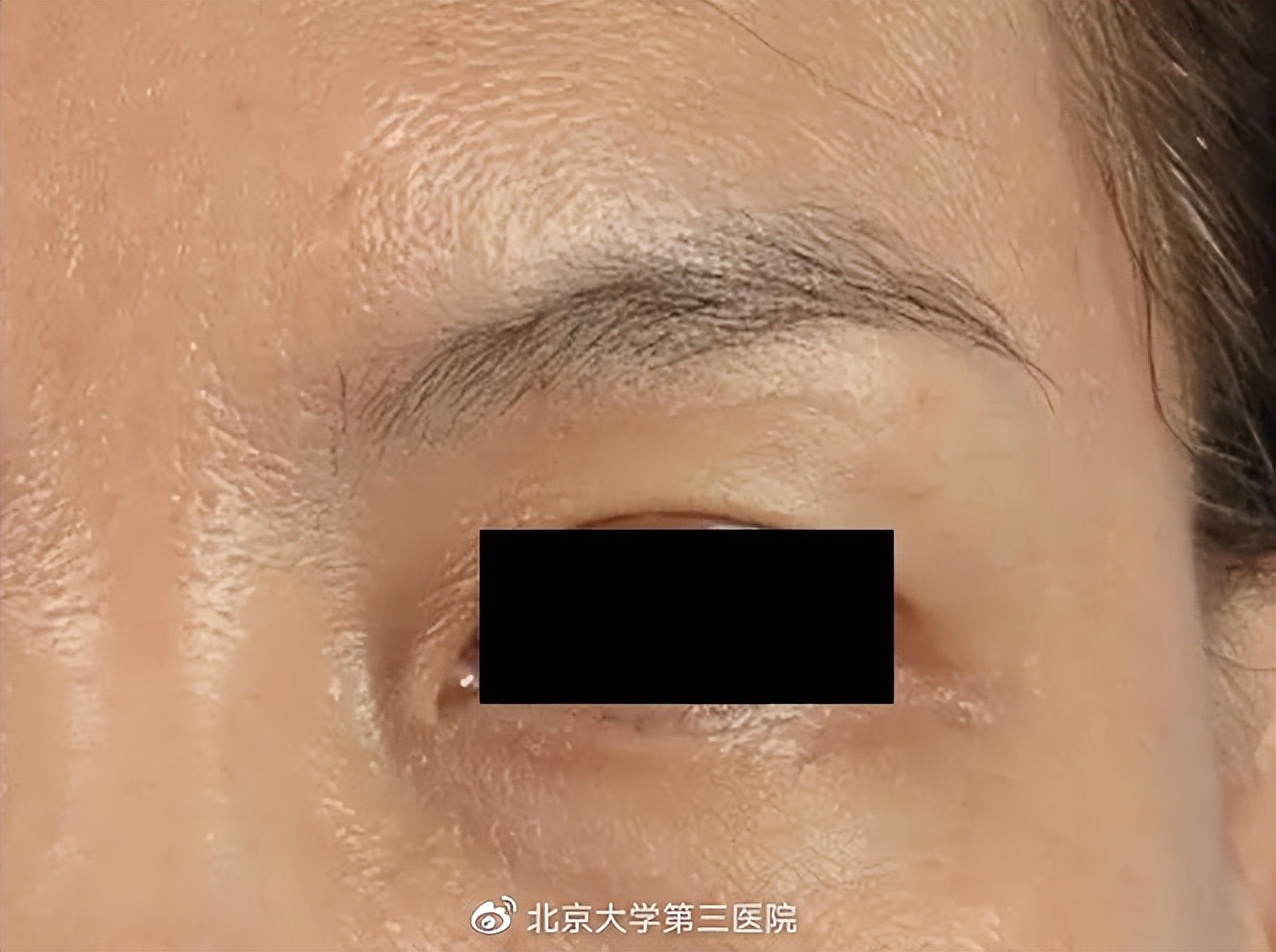 意外留疤怎么安慰,眉尾意外受伤留疤好不好