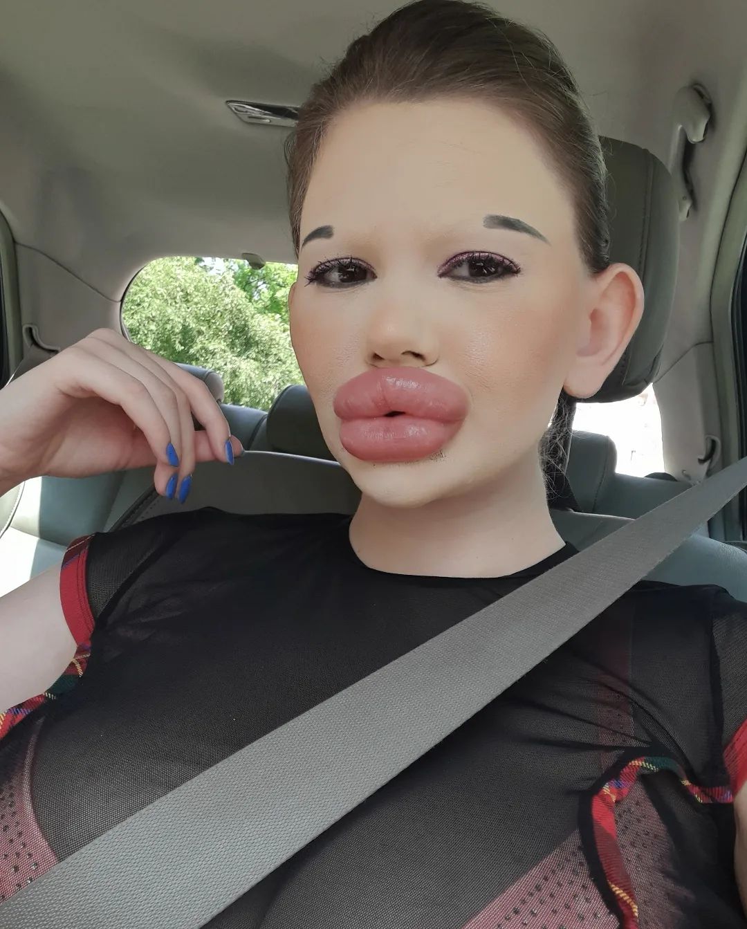 女子狂打30支玻尿酸,丰唇针建议打吗