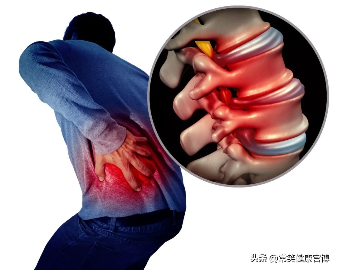 坐骨神经痛不用担心教你三招,坐骨神经痛怎么办最简单的方法