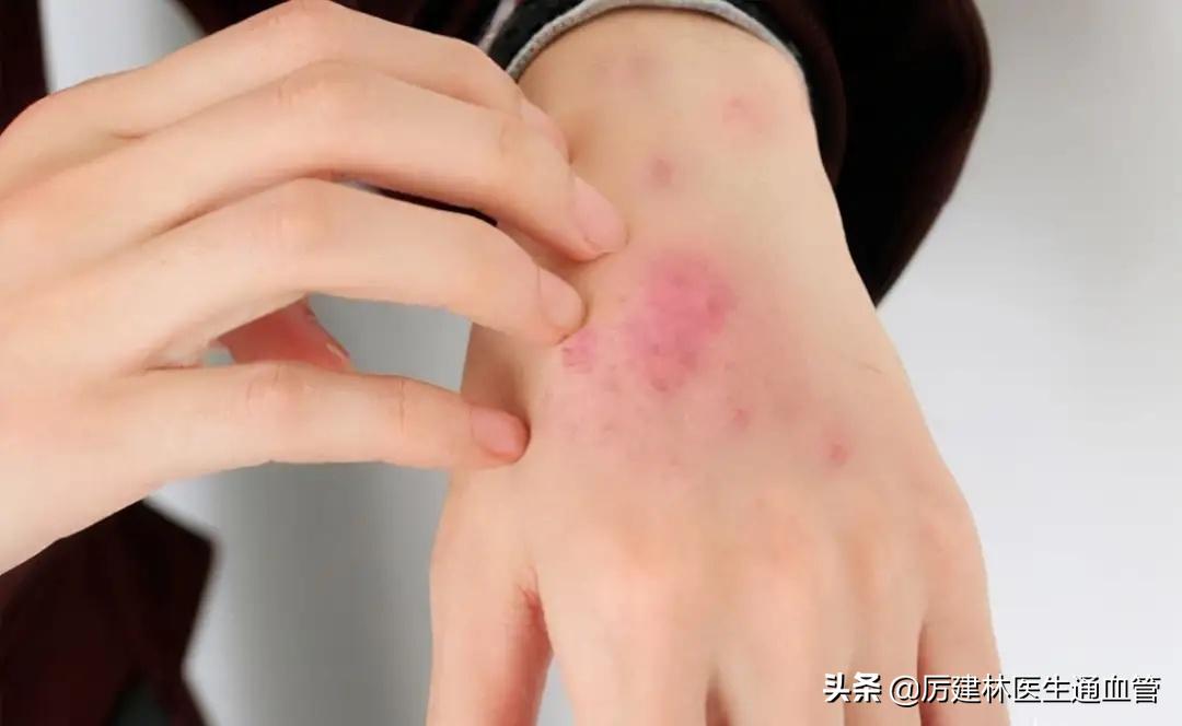 红霉素软膏和红霉素眼膏有何区别,红霉素软膏和红霉素眼膏具体区别