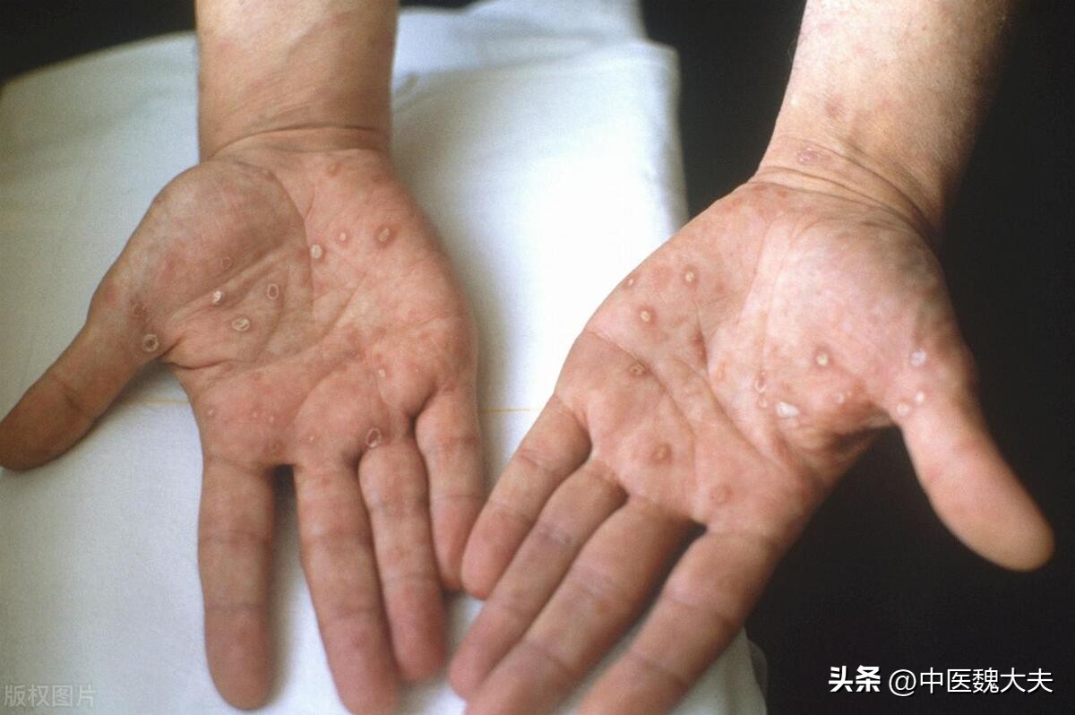 怎么辨别脚趾头缝是脚气还是梅毒,梅毒脚有哪些症状