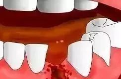 拔牙后不能吐口水怎么回事,拔牙后干槽症处理后注意事项