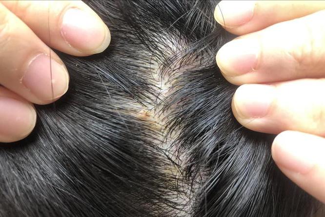 头皮长疙瘩和脓包怎么回事,头皮长脓包是怎么回事啊