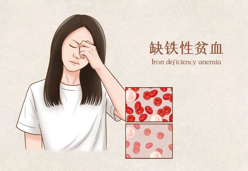 治疗缺铁性贫血的药物品牌,缺铁性贫血的药的名称