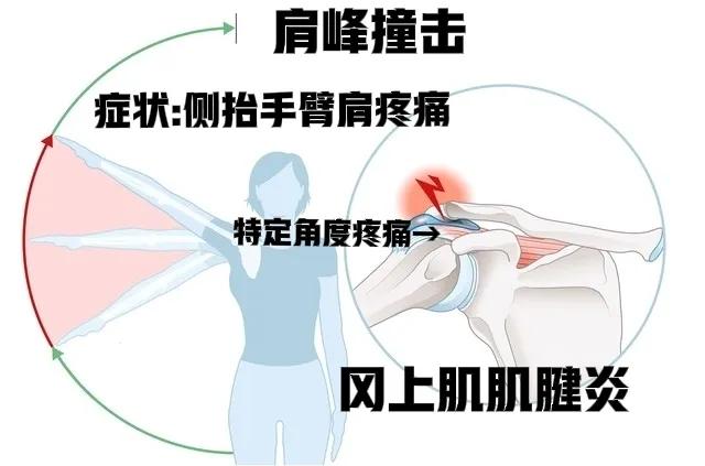 运动肩膀疼痛怎么缓解视频,运动肩膀僵硬紧绷怎么缓解