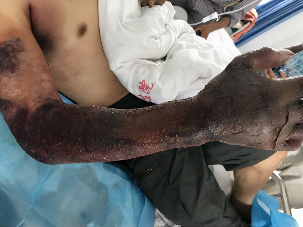 男子被五步蛇咬伤一刀斩断手指,男子被五步蛇咬后七孔流血