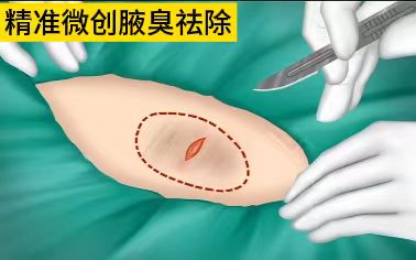 彻底治疗腋臭的方法,最新去除腋臭的手术方法