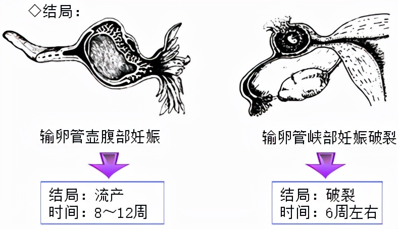 宫外孕孕妈会有危险吗,孕早期宫外孕会有什么症状和危害