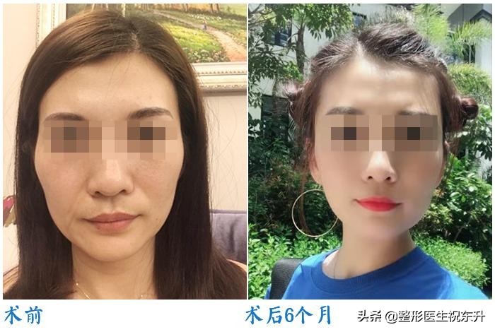 法令纹太深了怎么办？十有八九是这4种原因所致