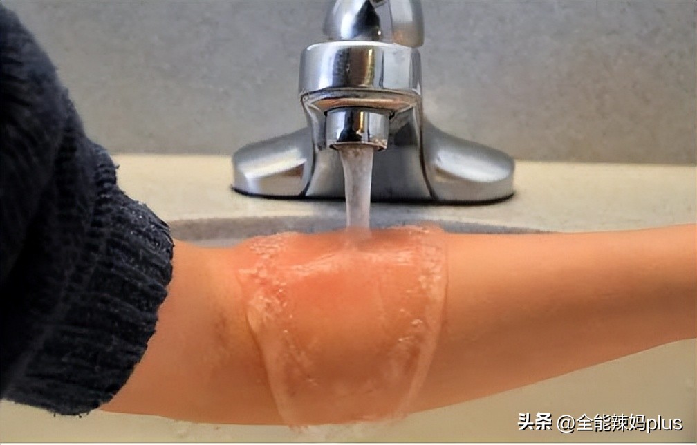 儿童开水烫伤毁容,9个月女婴被烫伤后续