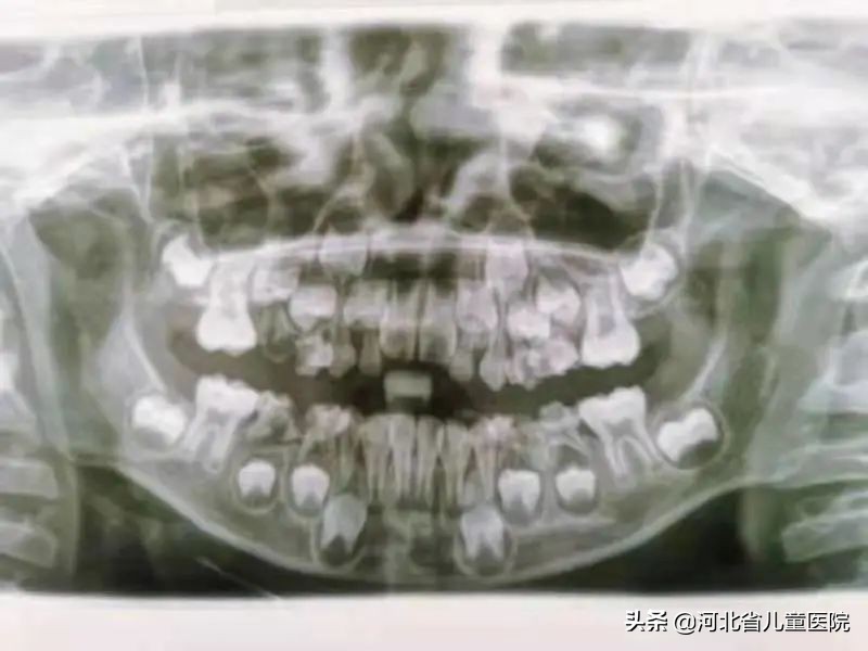 造血干细胞移植后口腔出现血泡,造血干细胞移植后口腔护理