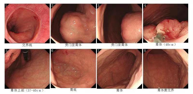 腹胀警惕癌症乏力,腹胀像皮球检查什么
